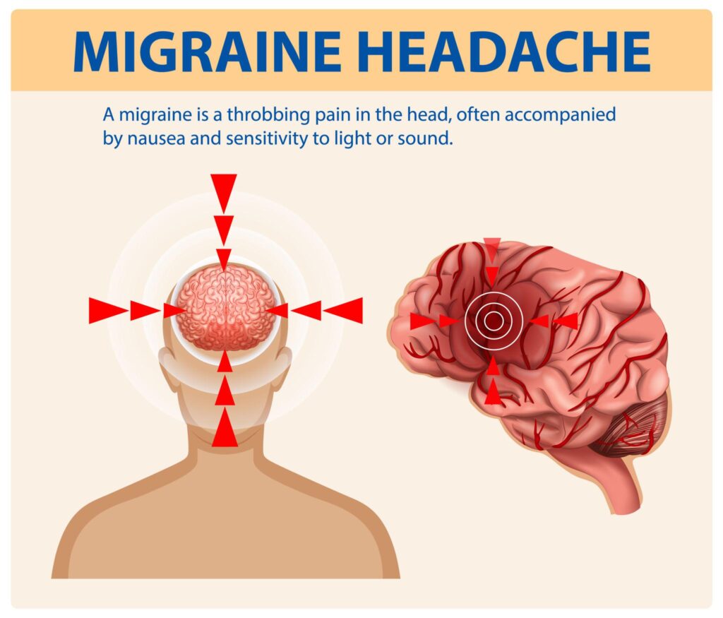 oxygen therapy for migraines
